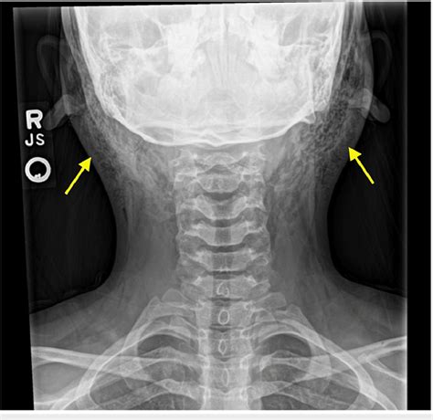 testing soft tissue of the neck|neck tissue imaging.